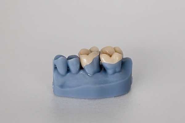 When A Dental Inlay May Be Your Best Restoration Option