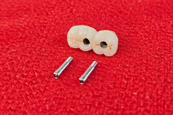 How To Make An Implant Crown Last